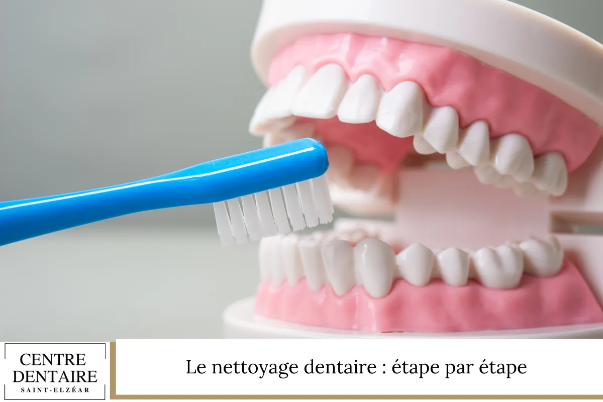 Le nettoyage dentaire : étape par étape