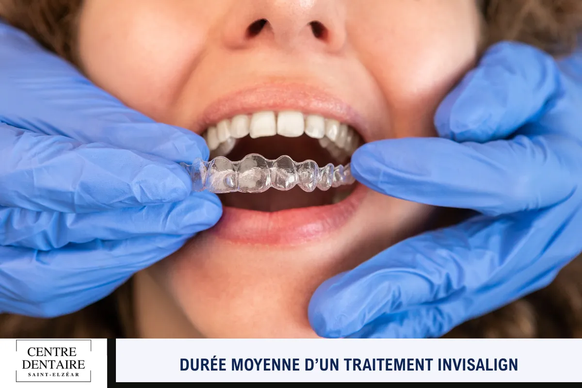 Durée moyenne d’un traitement Invisalign