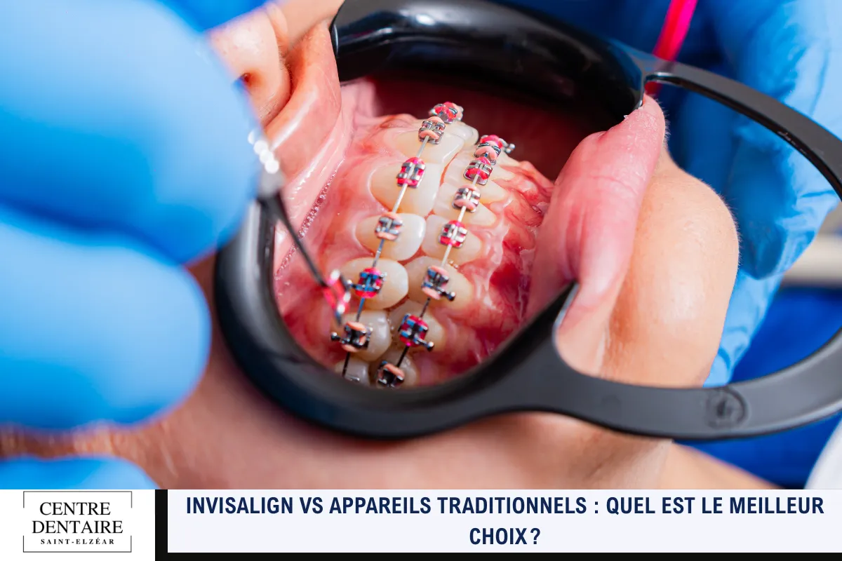 Invisalign vs appareils traditionnels _ quel est le meilleur choix 
