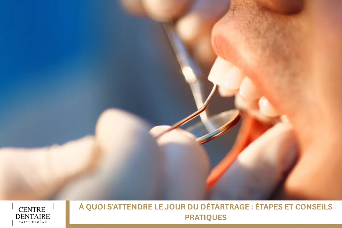 À quoi s’attendre le jour du détartrage : étapes et conseils pratiques