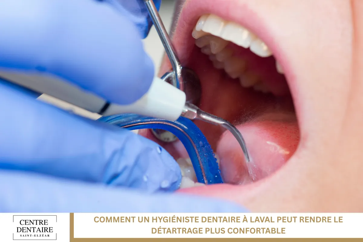 Comment un hygiéniste dentaire à Laval peut rendre le détartrage plus confortable